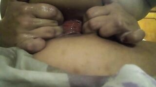 Fisting anal, pussy fist, prolapso anal, pussy prolapse